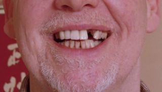 MISSING TEETH? TRY TEMPTOOTH   TEMPORARY TOOTH REPLACEMENT   DO IT 