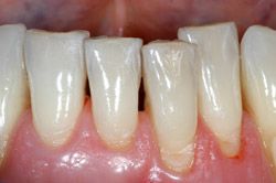 New Dental Air Polisher Dentist Teeth Polishing Prophy Jet Sand Gun 