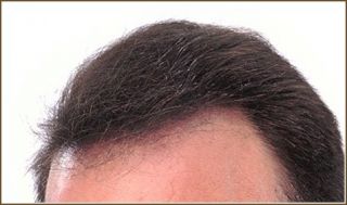 Dermmatch Hair Loss Concealer Latest Stock Dark Brown